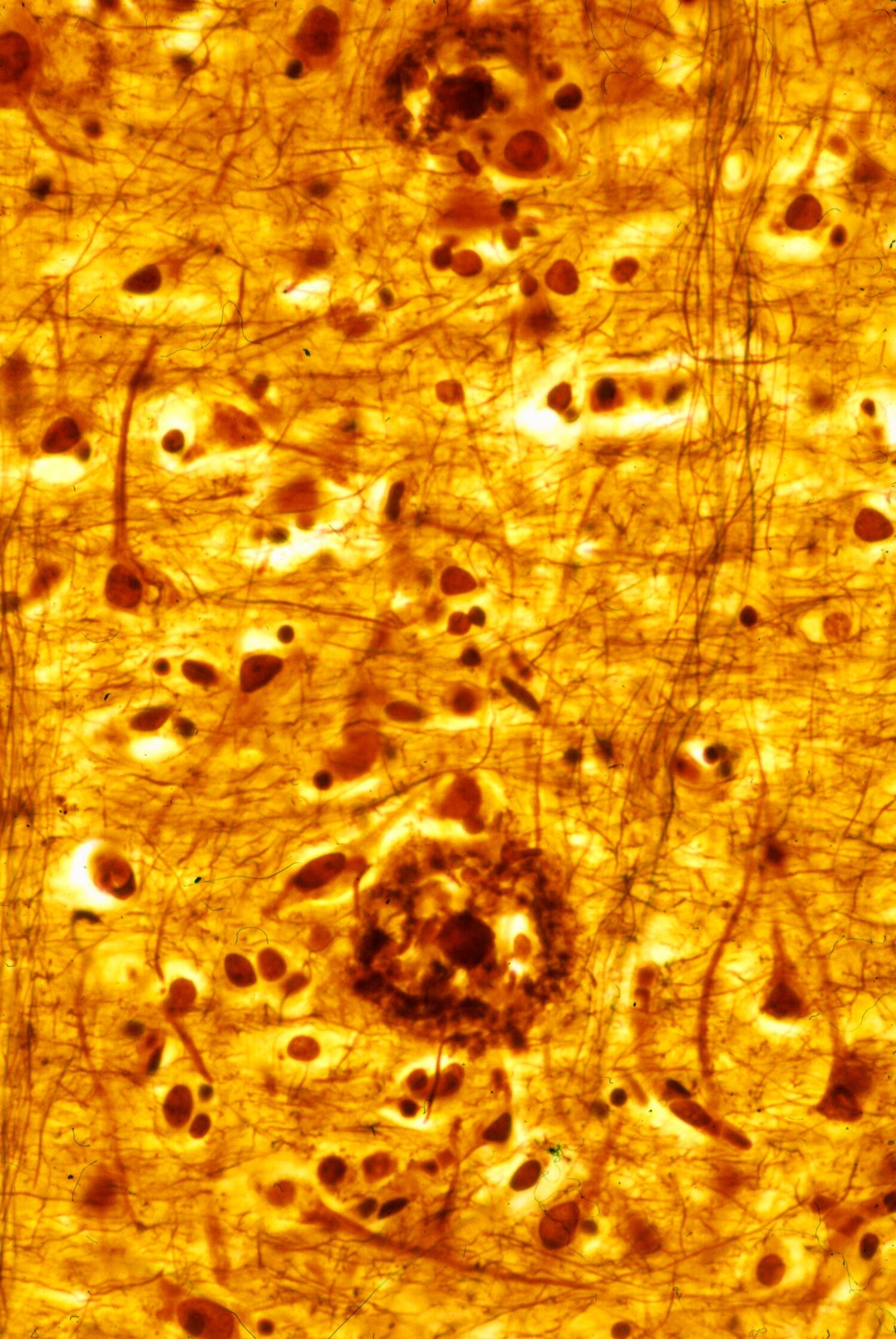 Microscopic scan of a person&apos;s cerebral cortex, stained in gold, shows the accumulation of plaques that can contribute to dementia symptoms